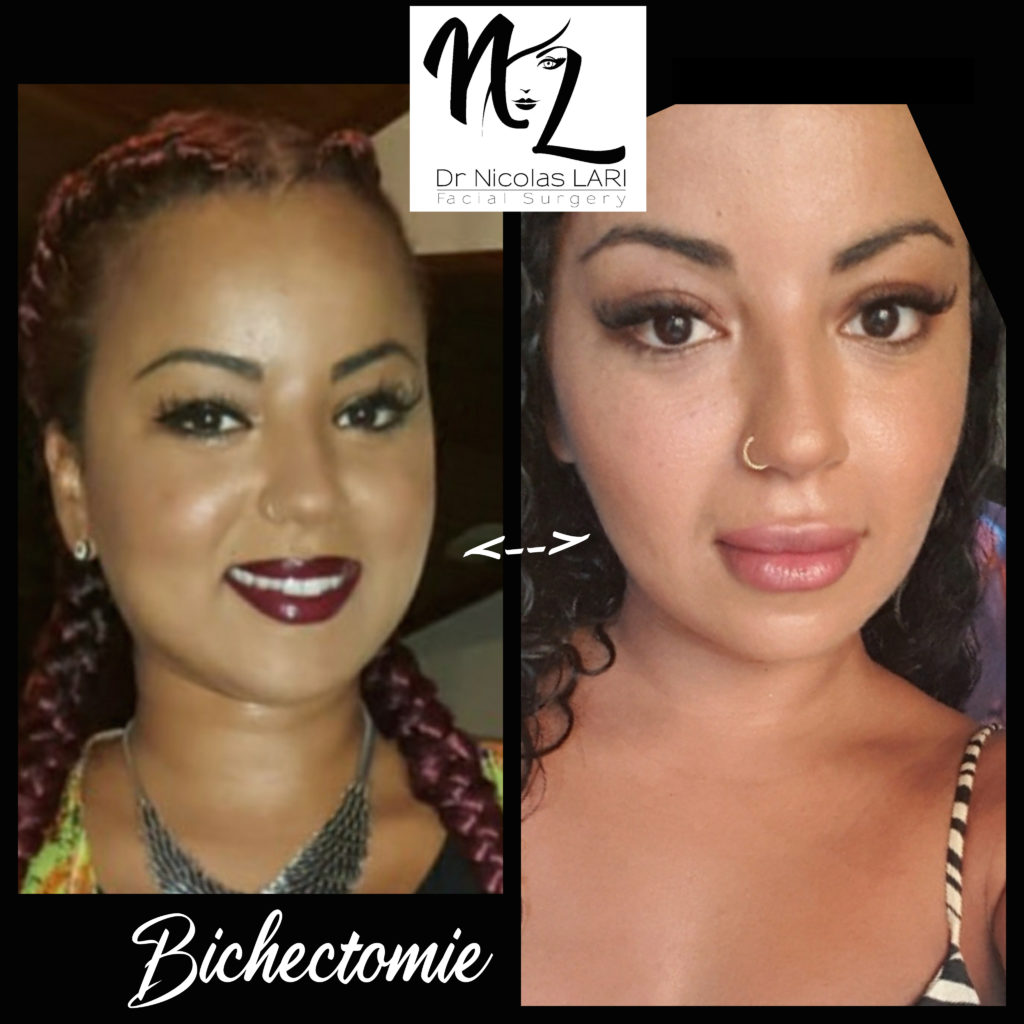 Bichectomie + Contouring affiner visage rong
